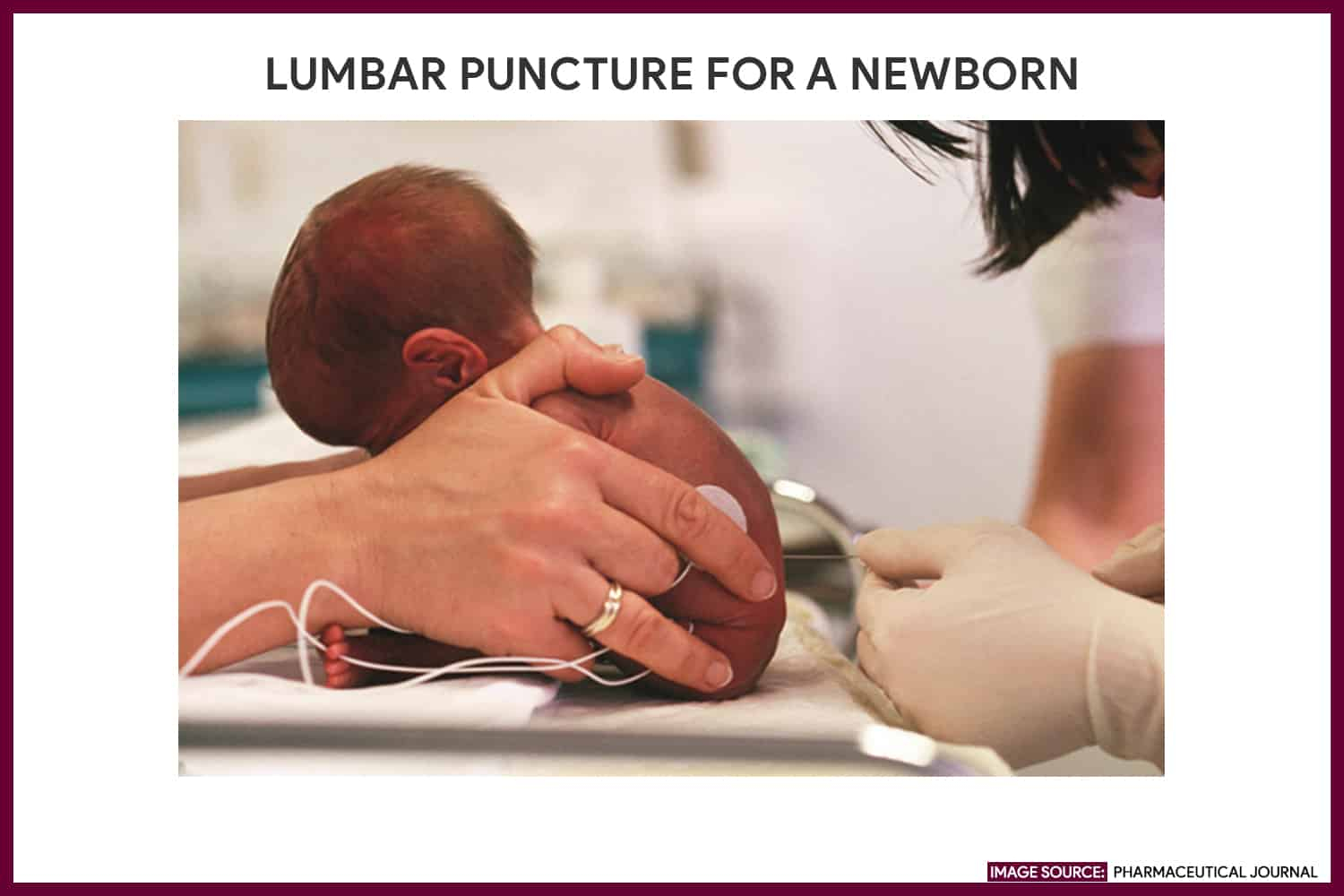 Lumbar Puncture (Spinal Tap) – Nursing Responsibilities Pertaining To Lumbar Puncture Procedure Note Template